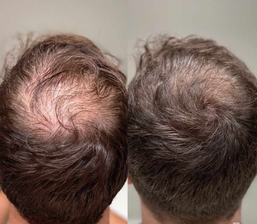 Side-by-side comparison photos of the narrator's crown showing early signs of hair regrowth after using rogaine for men. The left photo exhibits more visible scalp, while the right photo shows slightly denser hair coverage