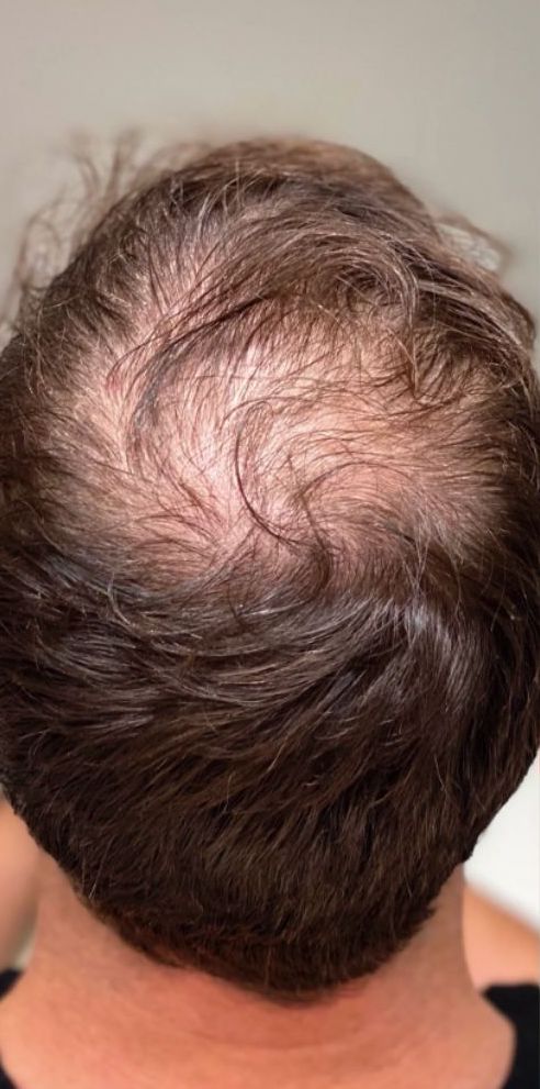 Close-up view of the back of the narrator's a  head showing thinning hair with visible scalp at the crown, highlighting the early stages of hair loss treatment with rogaine for men
