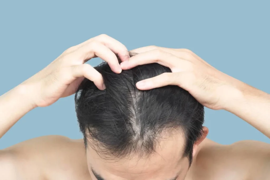 Top view of a man's head as he examines his thinning hair, focusing on a visible parting line with sparse hair coverage on a pale blue background before using rogaine