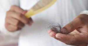 A detailed image showing hair loss with a comb in hand, symbolizing alopecia and related issues.